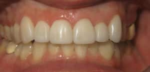 Veneers