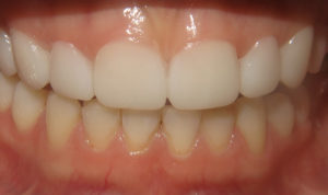Veneers