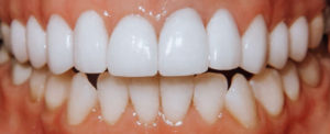 Veneers
