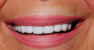 Veneers