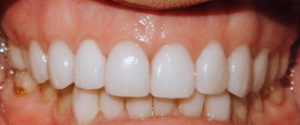 Veneers