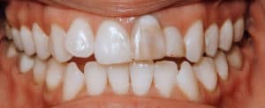 Veneers