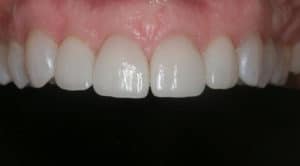 Veneers