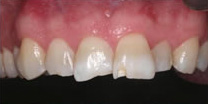 Invisalign Results Portland