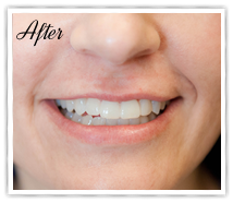 Trial Smile Results Portland