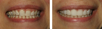 Trial Smile Before And After Photos Portland