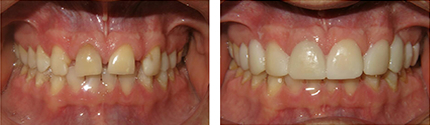 Trial Smile Before And After Photos Portland