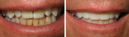 Trial Smile Before And After Photos Portland