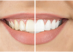 Teeth-whitening