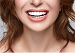 Veneers